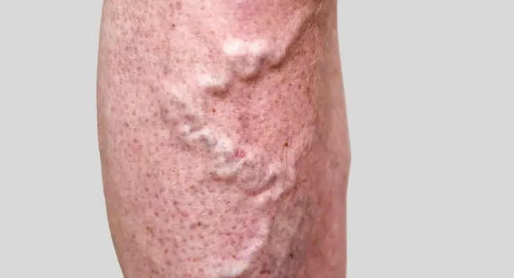 varices fes 